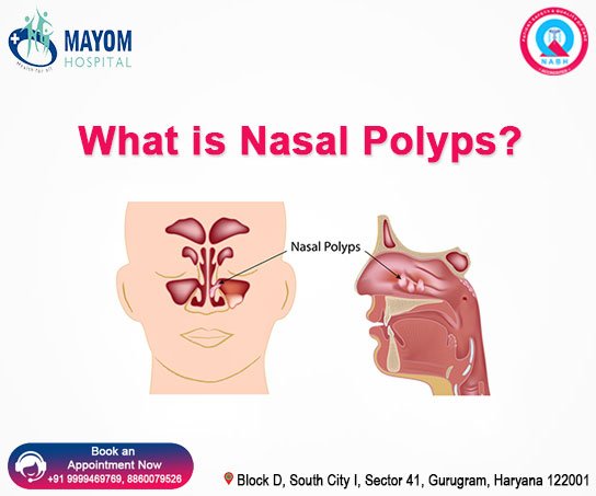 NASAL POLYPS