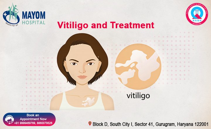 Vitiligo and Treatment 