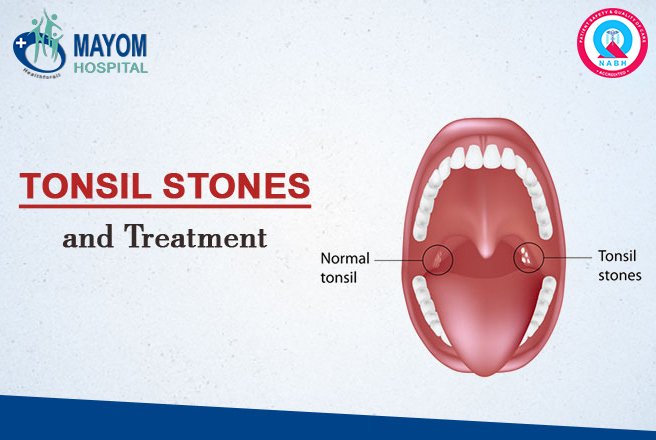 Tonsil Stones and Treatment