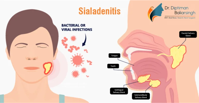 Sialendoscopy